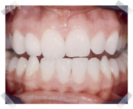 cosmetic dentistry after dark front tooth