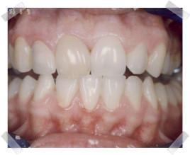 cosmetic dentistry before dark front tooth