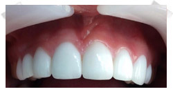 cosmetic dentistry after porcelain veneers