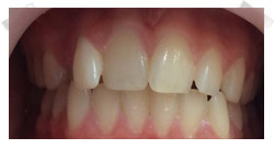 cosmetic dentistry before porcelain veneers