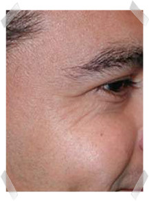 wrinkle treatment before eye smoothing