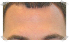 wrinkle treatment after forehead smoothing