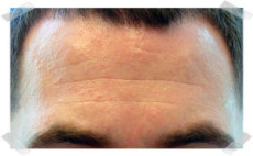 wrinkle treatment before forehead smoothing