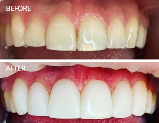 liverpool Composite Bonding 3