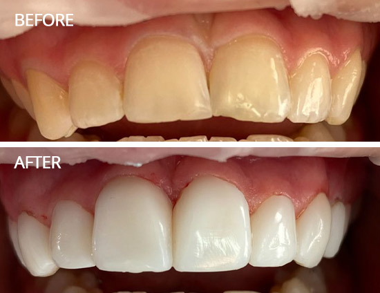 liverpool Composite Bonding