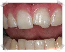 cosmetic dentistry before bonding