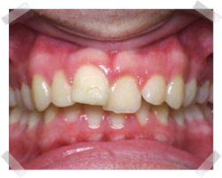 cosmetic dentistry before braces