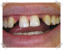 cosmetic dentistry before bridges