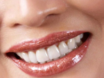 cosmetic dentistry veneers