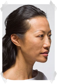 dermal fillers after nose shape adjustment