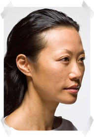 dermal fillers before nose shape adjustment