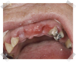 cosmetic dentistry before loss of anterior teeth