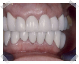 cosmetic dentistry after aged dentition