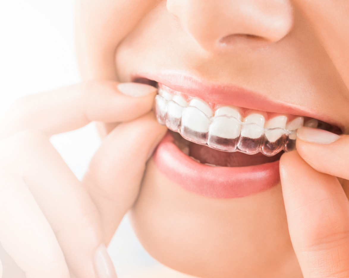 Invisalign