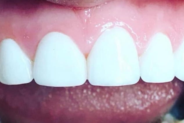 After - Khan Dental