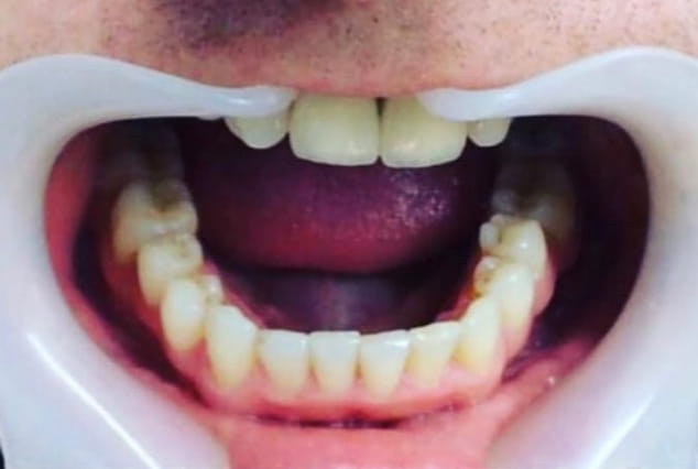 After - Khan Dental