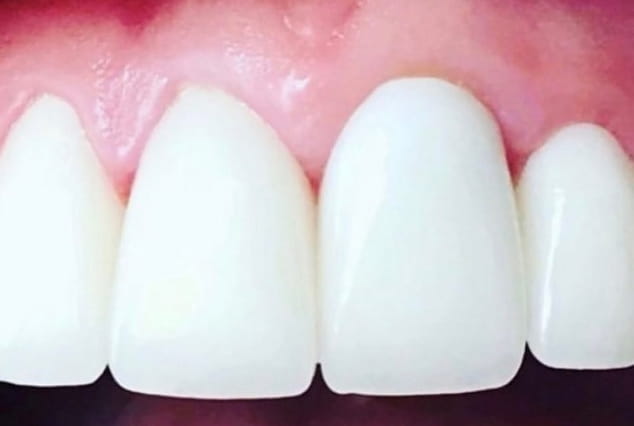 After - Khan Dental