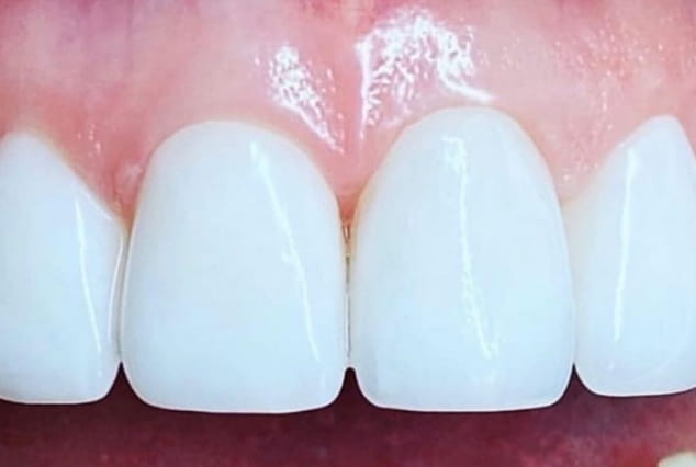 After - Khan Dental