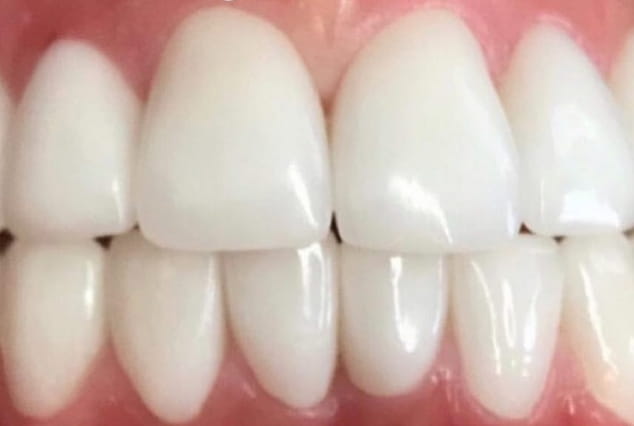 After - Khan Dental
