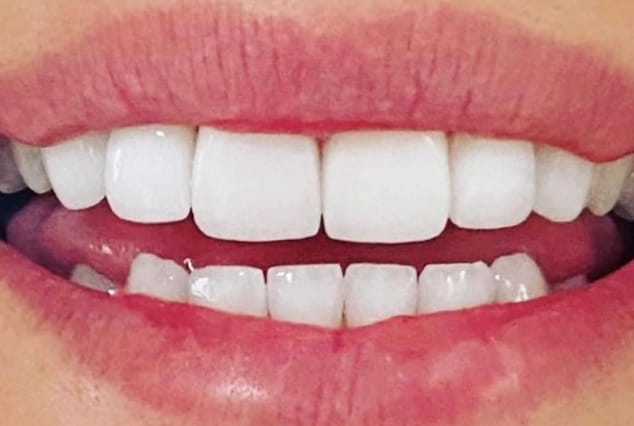 After - Khan Dental