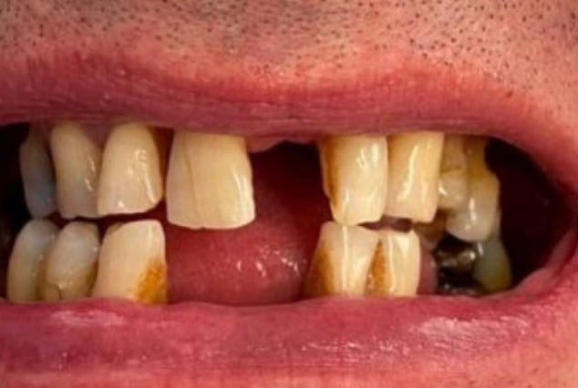 Before - Khan Dental