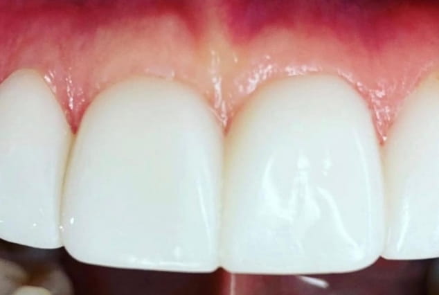After - Khan Dental