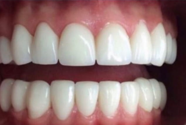 After - Khan Dental
