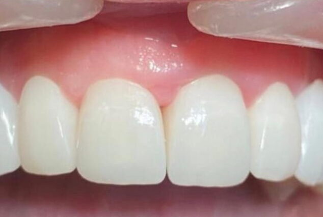 After - Khan Dental