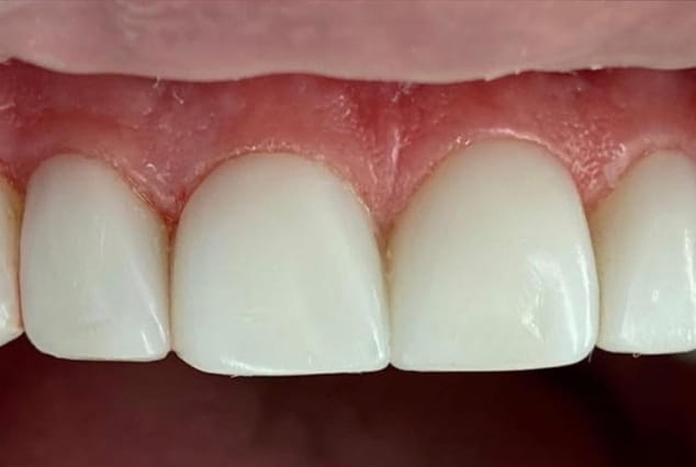 After - Khan Dental