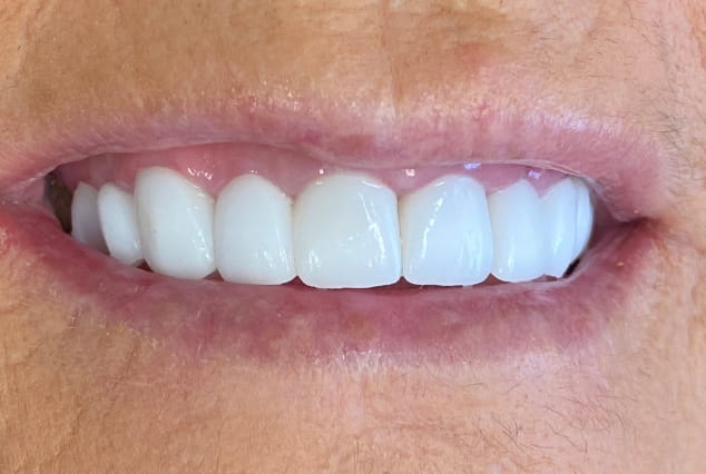 After - Khan Dental
