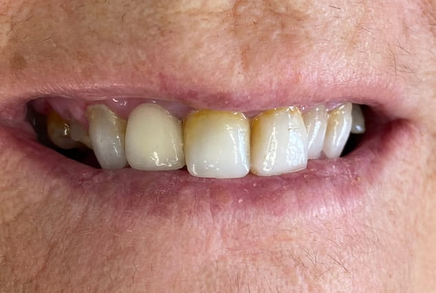 Before - Khan Dental