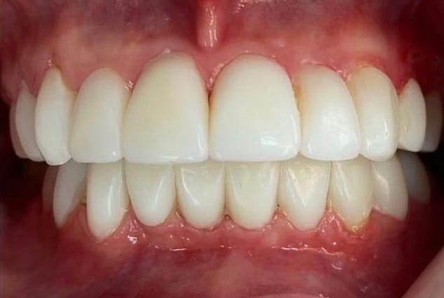 After - Khan Dental