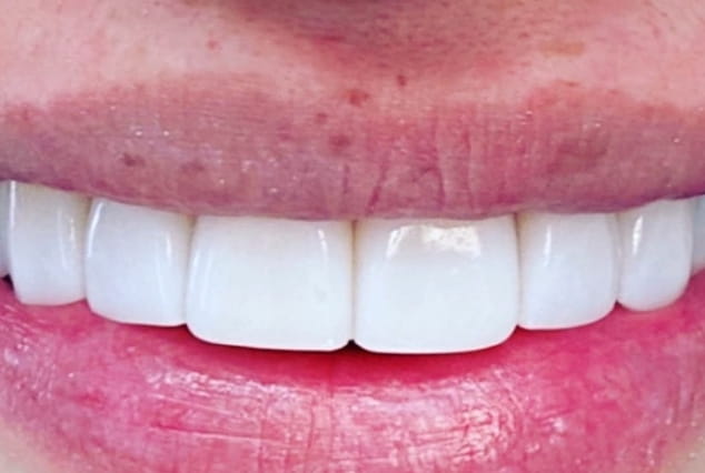 After - Khan Dental