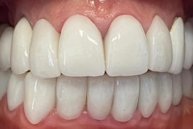 After - Khan Dental