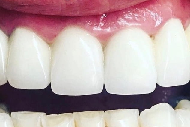 After - Khan Dental