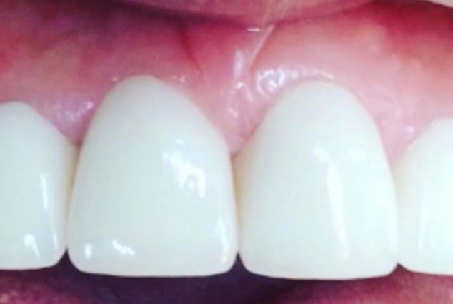 After - Khan Dental