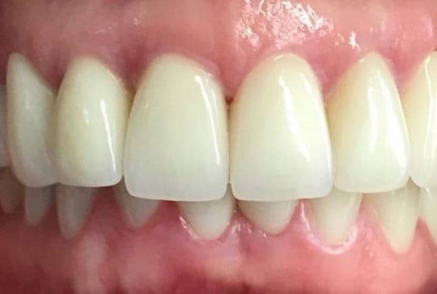 After - Khan Dental