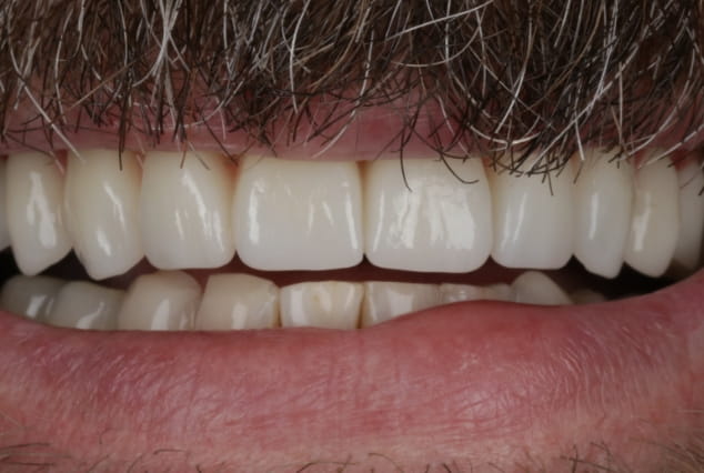 After - Khan Dental