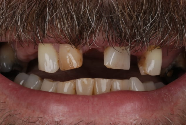 Before - Khan Dental