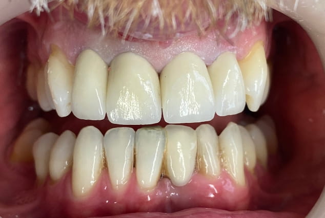After - Khan Dental