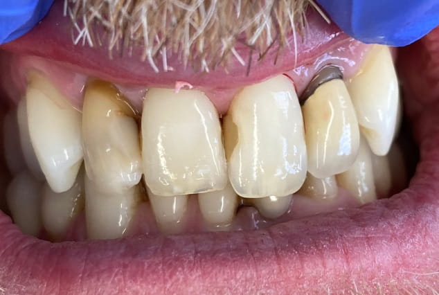 Before - Khan Dental