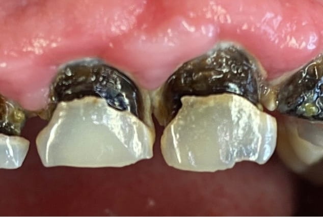 Before - Khan Dental