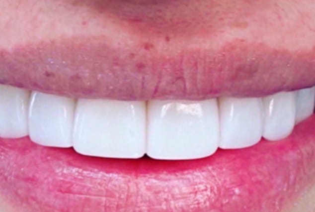 After - Khan Dental