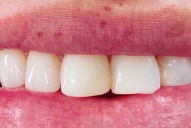 Before - Khan Dental