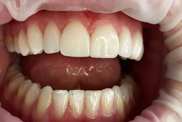 After - Khan Dental