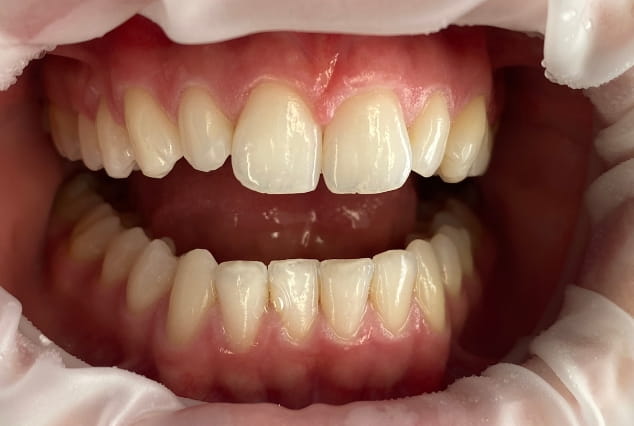 Before - Khan Dental