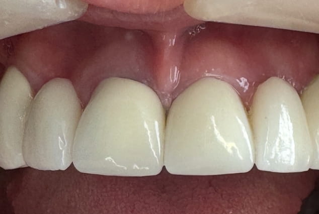 After - Khan Dental