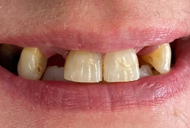Before - Khan Dental